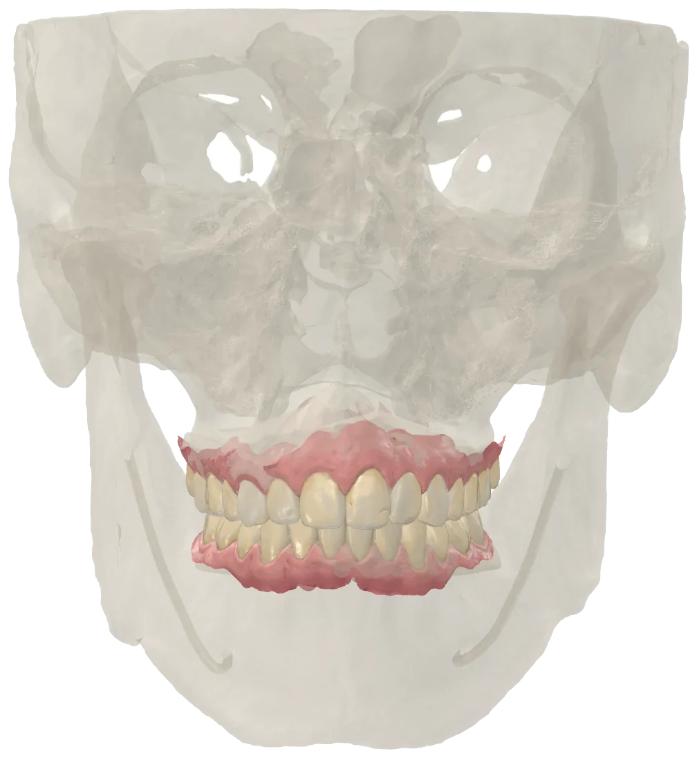 Intraoral scans with the skull mesh from a CBCT, for viewing only