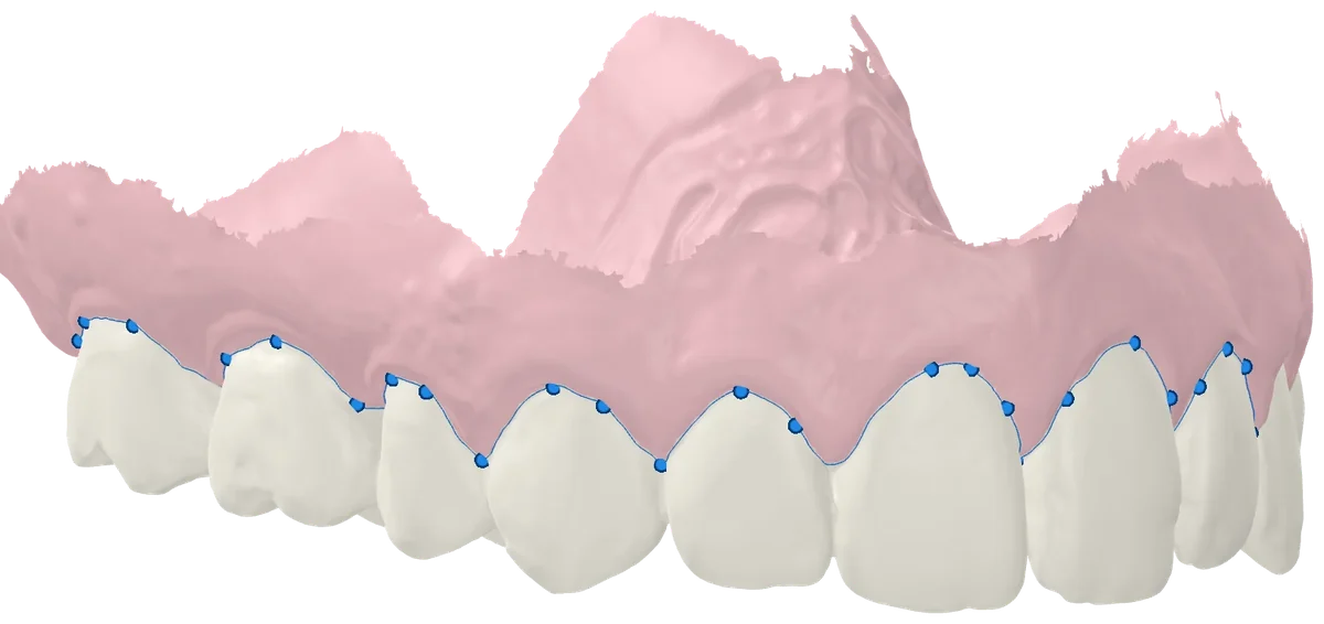 Gingival margin with its editable points