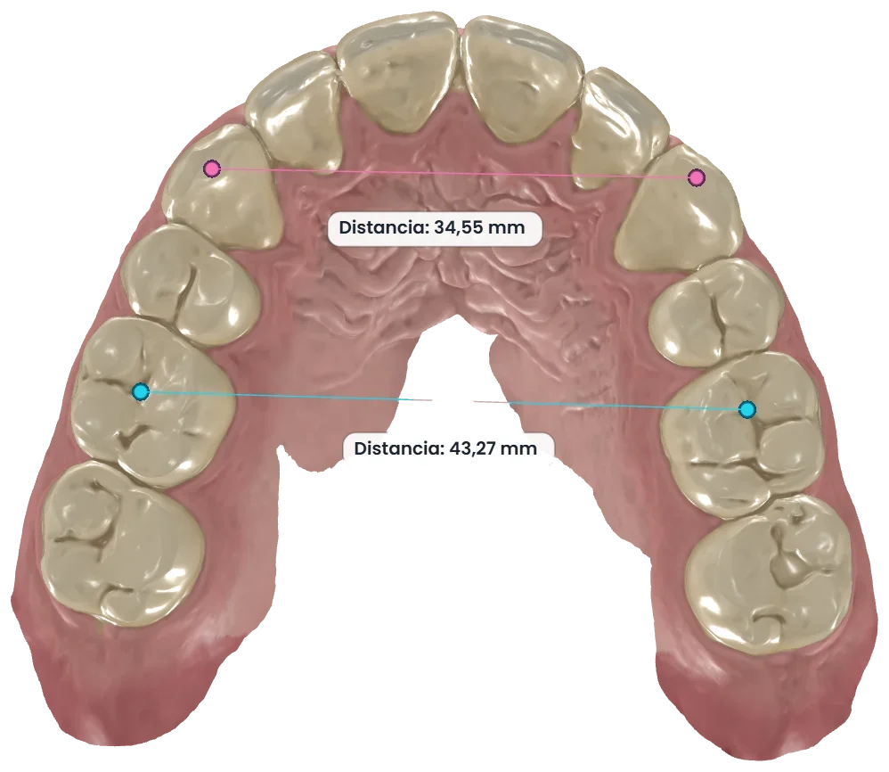 Distance measurements on the upper arch