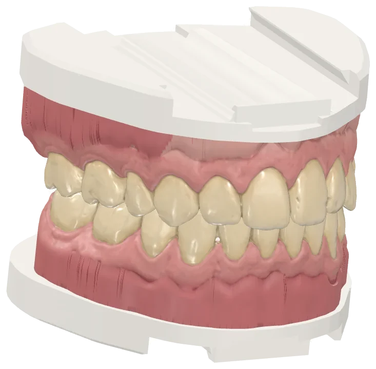 Models with their rail base for the analog articulator