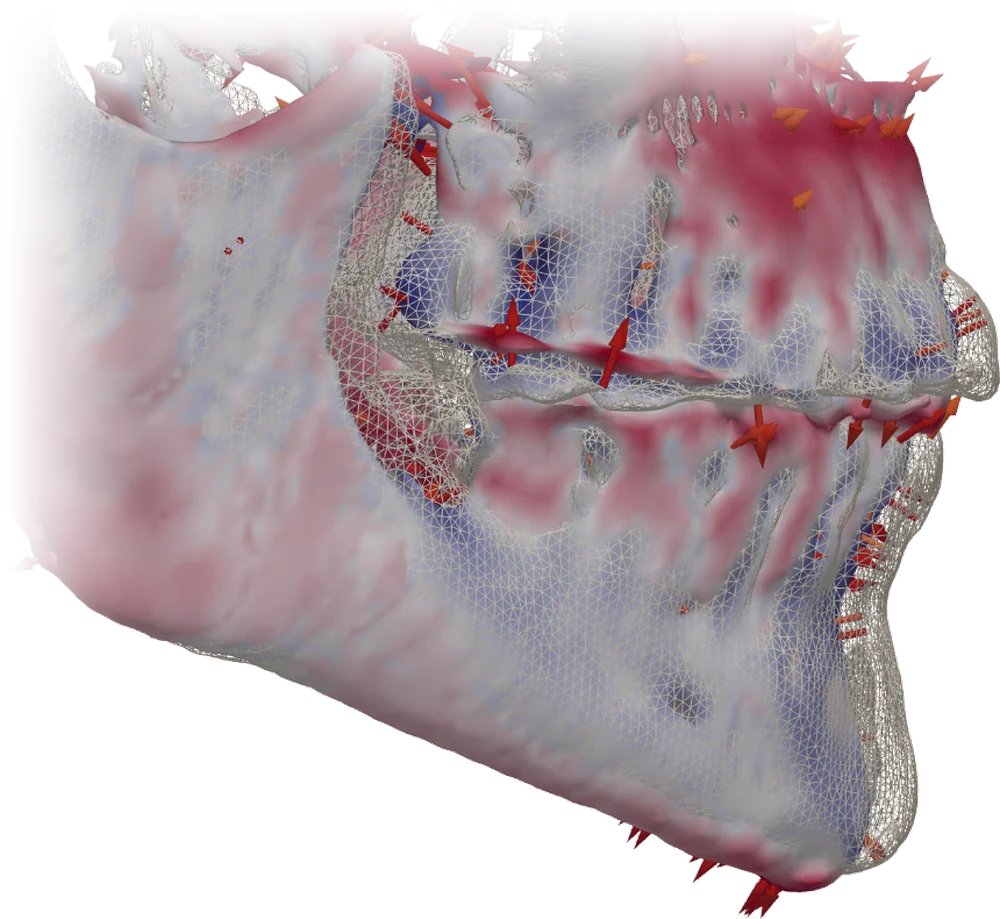 tresD DICOM: superimposition of two CBCTs with color map and arrows